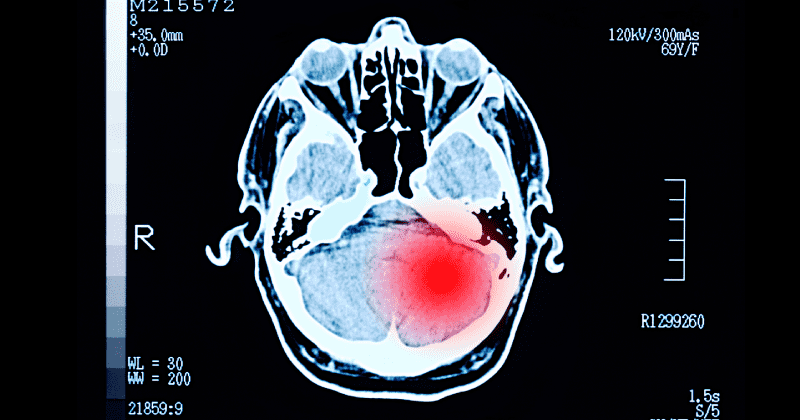 Sexual assault linked to brain damage in women, study finds