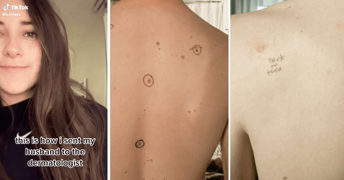 Wife circled husband's moles for dermatologist appointment. His doctor responded by rating each mole