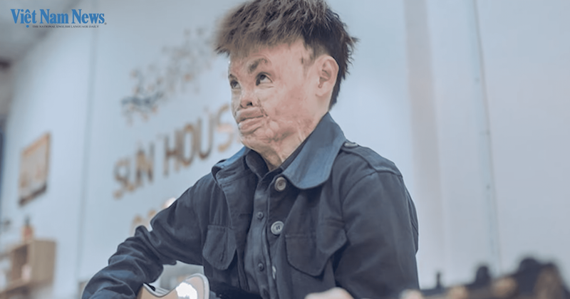 Burn survivor who didn't leave home for almost two years due to bullying opens his own bakery