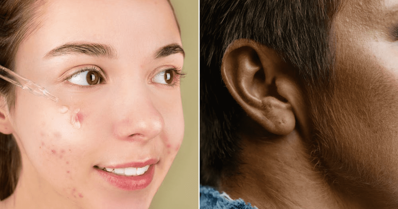 People can now search about their skin conditions with just a picture on Google Lens