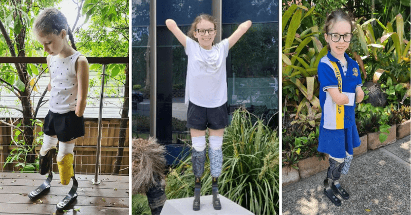 Young girl discovers the joy of walking with the help of prosthetic legs after suffering from Sepsis