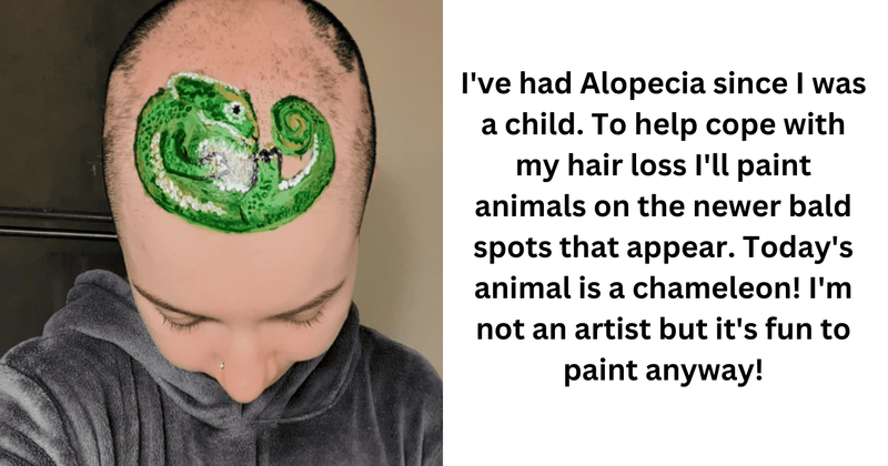 Girl bravely deals with alopecia by making beautiful art on her bald spots