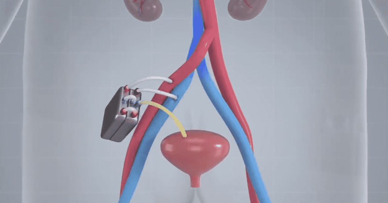 Implantable artificial kidney offers hope and relief to dialysis patients following promising trial
