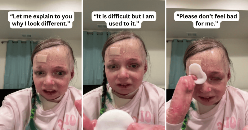 Teen with rare and painful skin disorder gets huge support on internet for sharing makeup tutorials